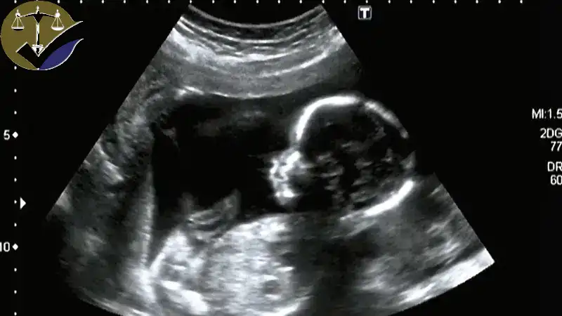 پیگیری حقوقی جرم سقط جنین در ایران جرم سقط جنین از نگاه قانون مجازات اسلامی